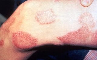 Сифилитическая розеола: фото, симптомы и лечение
