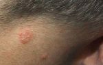Лечение себорейного дерматита на лице: принципы и методы терапии