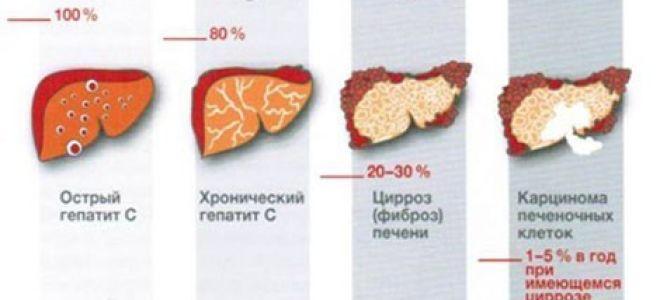 Вирусный гепатит a — причины, симптомы, диагностика и лечение