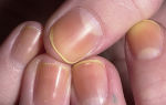 Желтые пятна на ногтях рук и ног: почему появляются, как избавиться