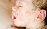 Атопический дерматит у детей: лечение и профилактика патологии