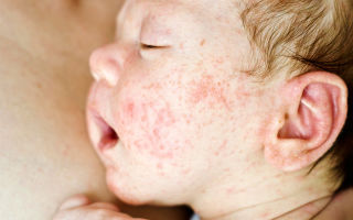 Атопический дерматит у детей: лечение и профилактика патологии