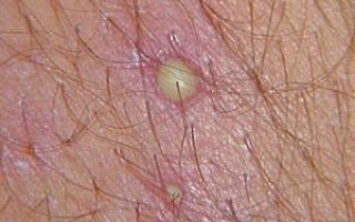 Пятна на коже с волдырями: фото, причины появления и лечение