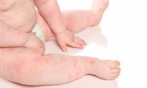 Сухие пятна на коже у ребенка: причины появления и лечение