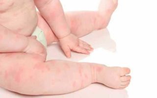 Сухие пятна на коже у ребенка: причины появления и лечение