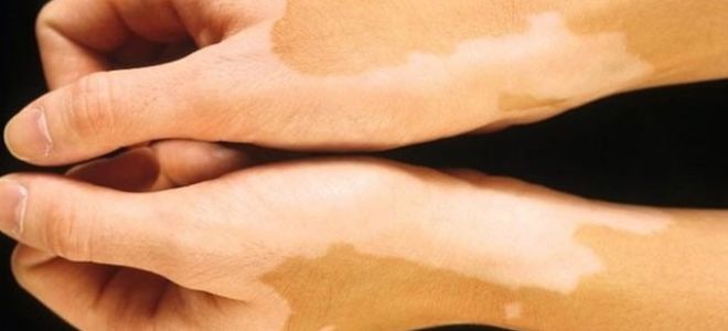 Старческие пятна на руках: почему появляются и как избавиться