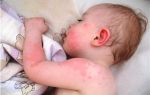 Токсическая эритема новорожденных: фото, симптомы и лечение патологии
