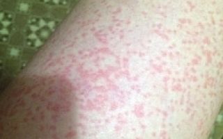Контактный кожный дерматит: что это такое, как проявляется, чем лечить