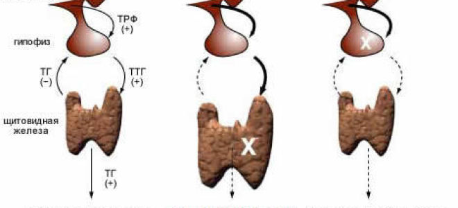 Вторичный гипотиреоз: 8 основных причин, лечение