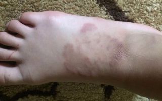 Пятно на косточке ноги или руки: причины образования, методы лечения