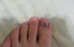 Красные пятна на пальцах рук и ног: фото, причины появления и лечение