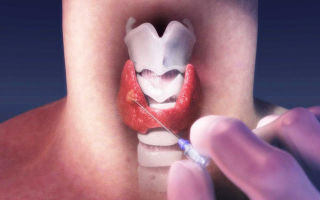 Уменьшенная щитовидная железа: причины и методы лечения у женщин и мужчин