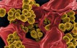 Бактериальный простатит: признаки, возбудители, причины, симптомы. как лечить хронический бактериальный простатит?