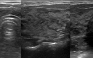 Допплерография щитовидной железы — диагностика болезней органа