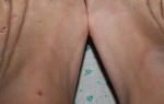 Волдыри на ступнях ног: причины и лечение