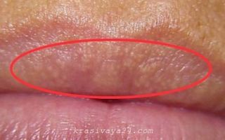 Пятна на губах под кожей: фото, причины возникновения и лечение