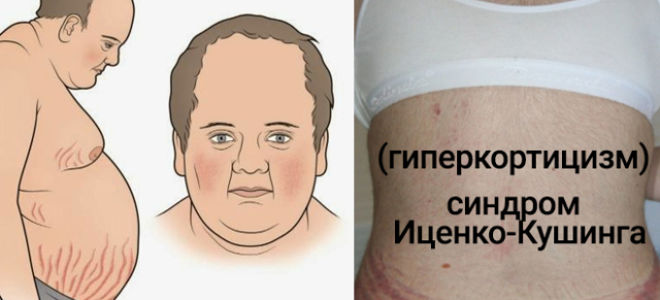 Медицинские препараты кортизола и их применение