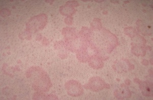 Аллергические пятна на теле