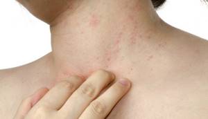 Чешутся волдыри на теле, спине, появились на коже у детей от укусов комаров и чешутся: причины и лечение