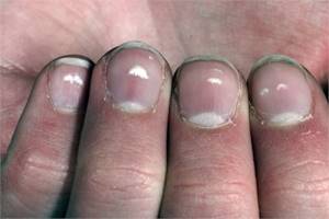 Белые пятна под ногтями и на ногтях рук