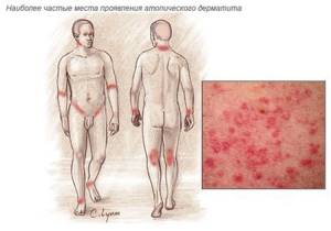 Лечение дерматита гомеопатией, травами, дегтем, лавровым листом