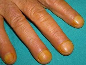 Желтые пятна на ногтях рук и ног