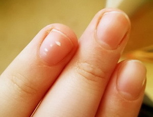 Белые пятна на ногтях у ребенка