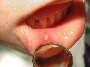 Белый волдырь на внутренней стороне губы у новорожденного ребенка, лечение