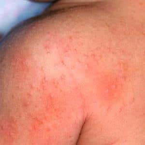 Детский дерматит: аллергический, атопический, себорейный