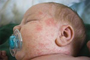 Токсическая эритема новорожденных