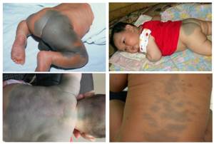 Пигментные пятна на теле, рук и ног, на коже под глазами у ребенка