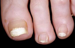 Что означают белые пятна на ногтях?
