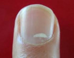 Белые пятна на ногтях пальцев рук - причины