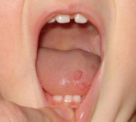 Волдыри в горле: причины, лечение, красные и белые волдыри у ребенка на задней стенке и языке