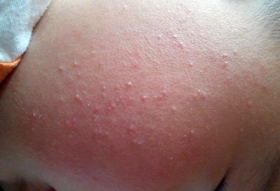 Чешутся волдыри на теле, спине, появились на коже у детей от укусов комаров и чешутся: причины и лечение