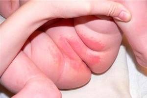 Быстрое лечение пеленочного дерматита у детей-грудничков