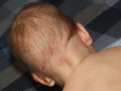 Появились красные пятна на голове у ребенка или младенца, чешутся и шелушатся