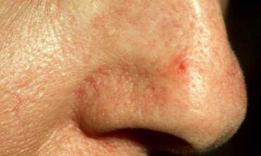 Пятно на носу: красное, пигментное, на кончике носа шелушится