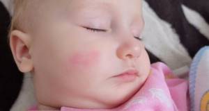 Шелушащиеся пятна на коже у ребенка: красные, розовые, на теле, голове, спине
