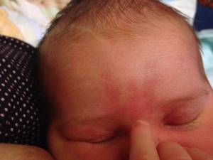 Появились красные пятна на голове у ребенка или младенца, чешутся и шелушатся