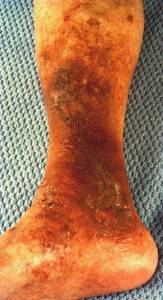 Пятна на ногах при варикозе: красные, тёмные, коричневые