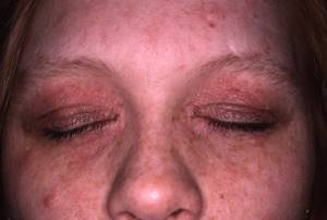 Аллергические пятна на теле