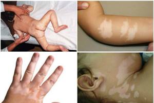 Пигментные пятна на теле, рук и ног, на коже под глазами у ребенка
