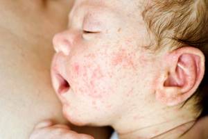 Лечение дерматита у детей
