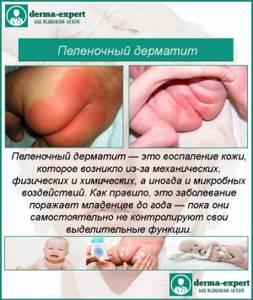 Быстрое лечение пеленочного дерматита у детей-грудничков