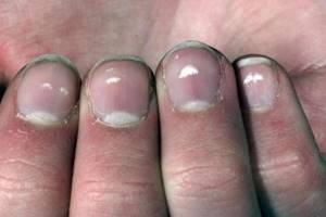 Белые пятна на ногтях пальцев рук