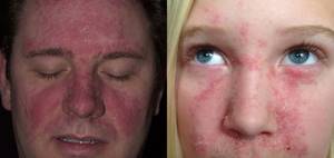 Лечение себорейного дерматита на лице