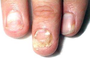 Желтые пятна на ногтях рук и ног