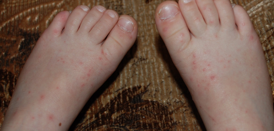 Появились волдыри на ступнях ног: причины и лечение, водянистые волдыри у ребенка
