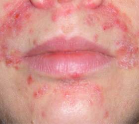 Народное лечение дерматита: себорейного, аллергического, перорального